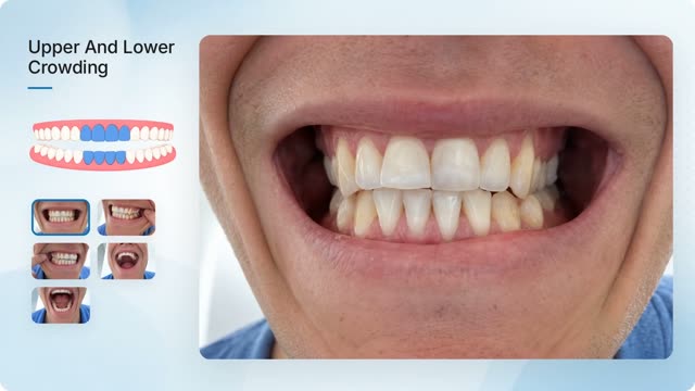 Video consultation scene: upper and lower crowding highlighted on a teeth map beside the patient's smile photos