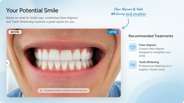 Before and after smile simulation for clear aligners and teeth whitening, with the recommended treatments